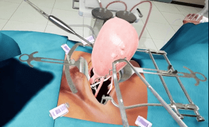 An early stage of the hysterectomy simulation showing clamping of the uterine vessels